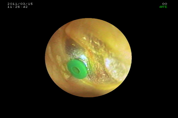 次に、鼓膜切開をしてもまたすぐに膿汁が溜まってしまう場合には、鼓膜を切開した後に膿汁の出口と換気を兼ねたチューブを入れる「鼓膜チューブ留置術（チュービング）」を行います。